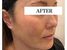 プシュケ(PSYCHE)/ADSでのシミケア＊AFTER