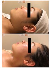 エイシスグロウ(asis glow.)/効果写真