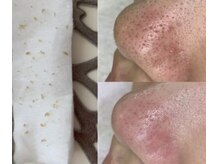 サロンド シェリー(Salon de Cherie)の雰囲気（お肌に負担なく、黒ずみ・毛穴汚れ改善☆滑らかなゆで卵肌へ♪）