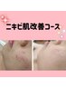 【ニキビ・肌荒れにアプローチ！】プラズマ光フェイシャルニキビ肌ケア¥6,200