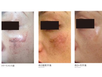 ブロッサム(Blossom)/韓国式白雪肌スノーピーリング