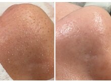 スア(SUA)/ハイドラビフォーアフター