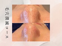 毛穴の汚れを取って、引き締めてあげるとこんなにも変わります♪