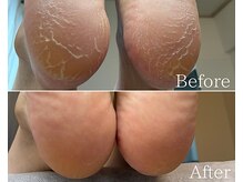 カシェット 広島店(Cachette)/50代女性☆足裏角質ケア90分