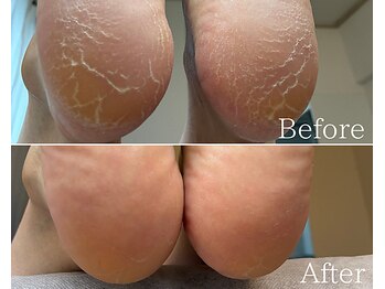 カシェット 広島店(Cachette)/50代女性☆足裏角質ケア90分