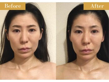 モモスパ(MOMOspa.)/頭蓋骨小顔矯正ビフォアフター