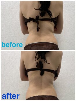 ハロ 南青山(HALO)/全身キャビラジ1回目