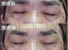 アイプロ/【6】スッキリ目元を実感