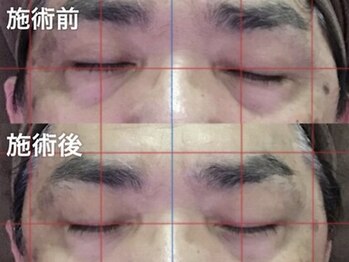 アイプロ/【6】スッキリ目元を実感