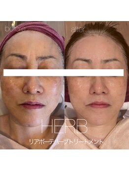 アンク(Ankh)/肌の救世主ハーブトリートメント