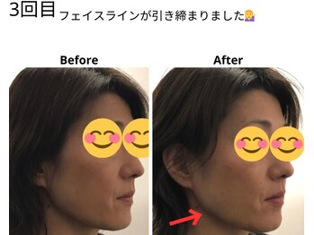 ベル/50代の方の小顔Before After