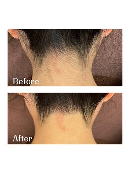 ギルドハナレ(GUILD HANARE)/【うなじ脱毛ビフォーアフター】