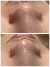 ヴィヴィエ 佐賀店(ViVier)/毛穴ケア症例　1回