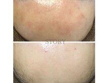 ストーリー 岐阜店(STORY)/ハーブピーリング専門店STORY