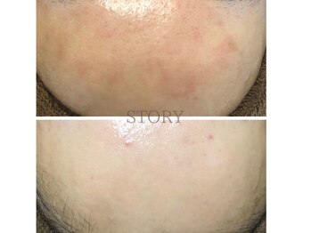 ストーリー 岐阜店(STORY)/ハーブピーリング専門店STORY