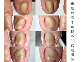 どんな巻き爪も対応可