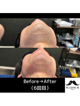 プラチナムニイガタ 新潟(PLATINUM NIIGATA)/ヒゲ脱毛