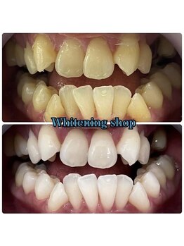 ホワイトニングショップ 池田店/【BEFORE/AFTER】