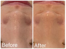 サロンドフェイス(Salon de Faith)/ハーブピーリング2回