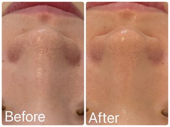 サロンドフェイス(Salon de Faith)/ハーブピーリング2回