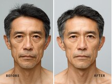 ミネルバ(MINERVA)/施術例 50代男性　フェイシャル