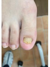 フットメンテ 巻き爪矯正センター 南浦和/変形爪　施術前