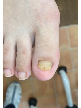 フットメンテ 巻き爪矯正センター 南浦和/変形爪　施術前