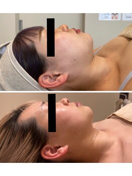 エイシスグロウ(asis glow.)/効果写真