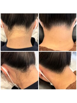 フォーケア(4Care)/WAX＋光脱毛