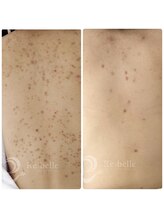 ビースキン 藤沢店(BeSkin)/背中リベルハーブ(DT有)