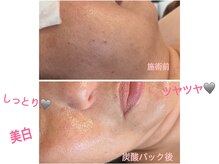 アルーア(Allure)/大人気炭酸パック前後♪