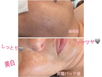 アルーア(Allure)/大人気炭酸パック前後♪