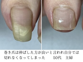 爪切り/巻き爪ケア