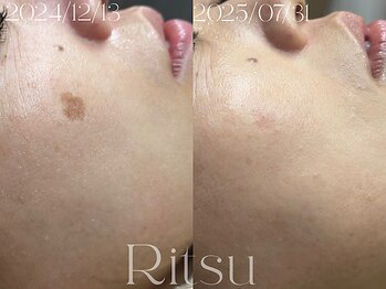 リツ(Ritsu)/シミケア当て放題