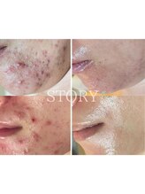 ストーリー(STORY)&nbsp;ハーブ ピーリング