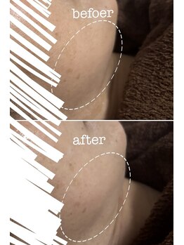 ひびき 京都烏丸御池店/プラズマ+EMS小顔フェイシャル