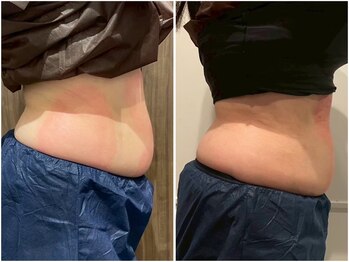 ビュウナ 銀座(BEAUNA)/脂肪冷却/frozen8