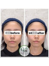 キュープ 相模原淵野辺店(Qpu)/たった4回で人生で1番小さな顔に