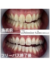 ホワイトニングサロン 京都烏丸店/ホワイトニング施術例