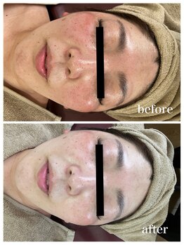 ジャスミン(Jasmin)/たるみ改善コース