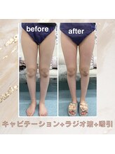 ハロ 南青山(HALO)/キャビテーション+ラジオ波+吸引