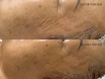 レイル(REIR)/メニュー:純粋レチノールピール