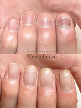 マリーロール 淀屋橋本店(Marie Laure)/自爪育成/深爪矯正/ネイルケア