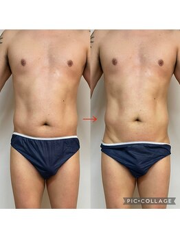 リリーローズ(LilyRose)/おなかやせ