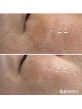 アネラ キキ サロン(anela kiki salon)/美肌肌質改善VOSサロンケア