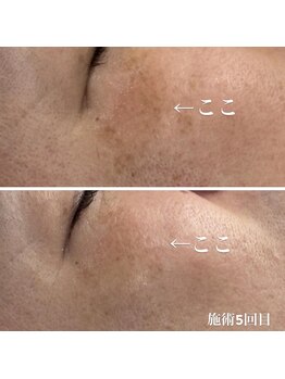 アネラ キキ サロン(anela kiki salon)/美肌肌質改善VOSサロンケア