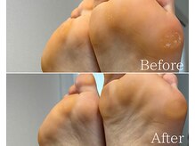 カシェット 広島店(Cachette)/40代女性☆足裏角質ケア90分