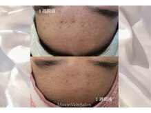 マウム(Maum)の雰囲気（プラズマ×水玉リフティングでピーリングに頼らない肌質改善も◎）