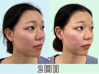 ナチュラルビューティーフェイス 横浜(NBF)/リフトアップした横顔/小顔矯正