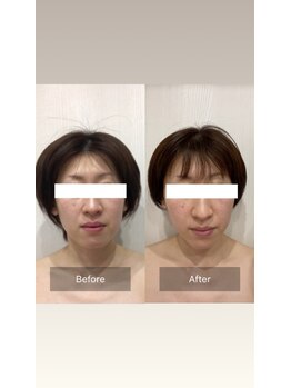 パラフューズ 札幌店 ブランジュ(PARAFUSE.)/脳洗浄before after